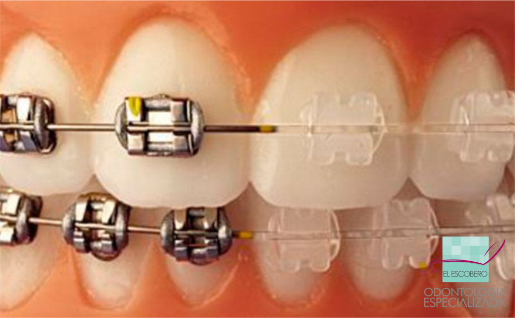 ¿Cuánto dura un tratamietno de ortodoncia con brackets cerámicos?